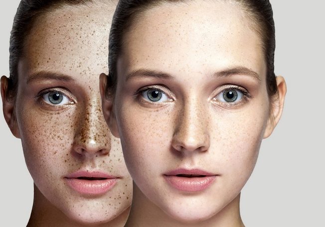 How to Get Rid of Skin Pigmentation