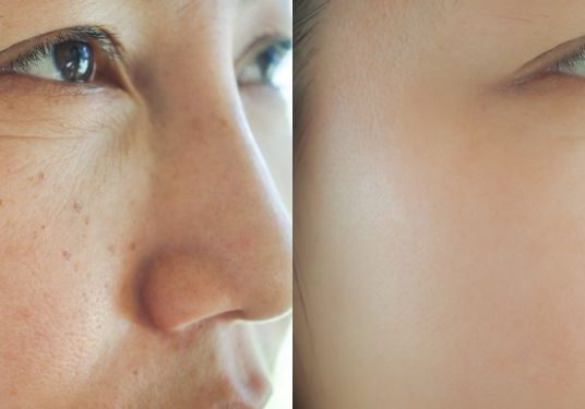 Treatment for Melasma