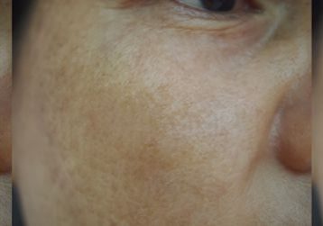 Causes of Skin Pigmentation