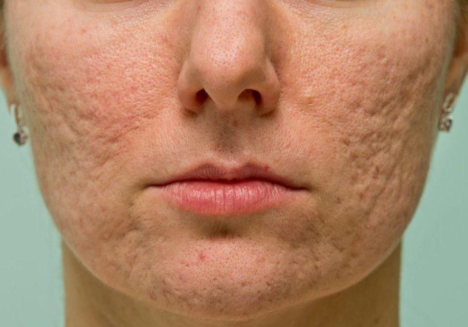 The Fastest Way to Clean Up Acne Scars | Laser Acne Treatment
