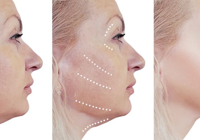 non-surgical facelifts
