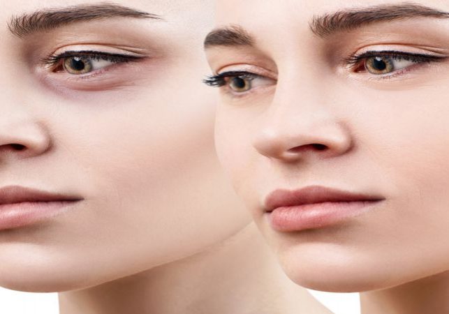 Under Eye Filler Treatments