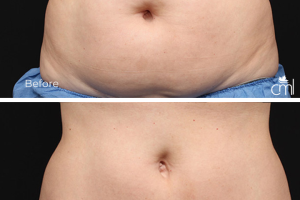 Body Contouring Treatment before and after image
