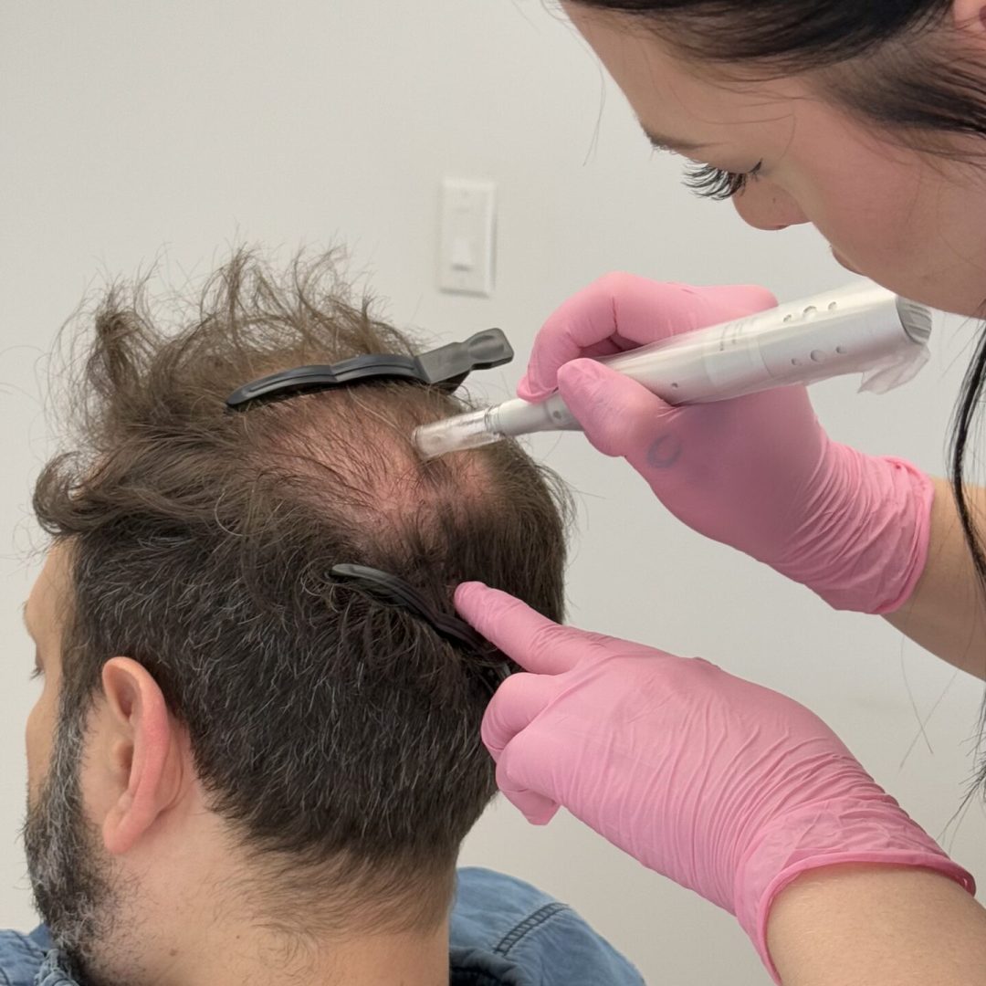 Hair Restoration - Canada MedLaser
