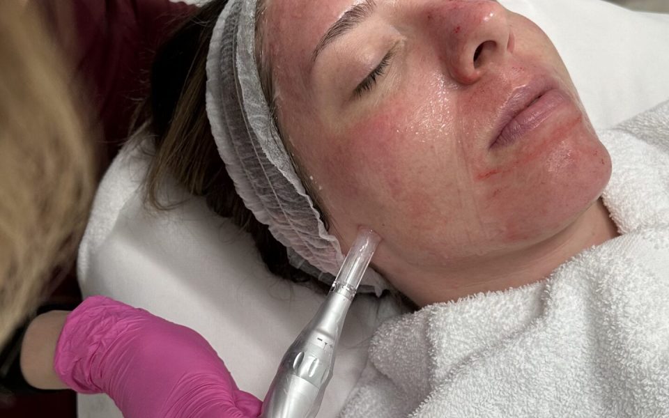 Facial - Canada MedLaser