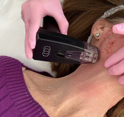 Morpheus8 Morpheus8 Treatment at Canada Medlaser