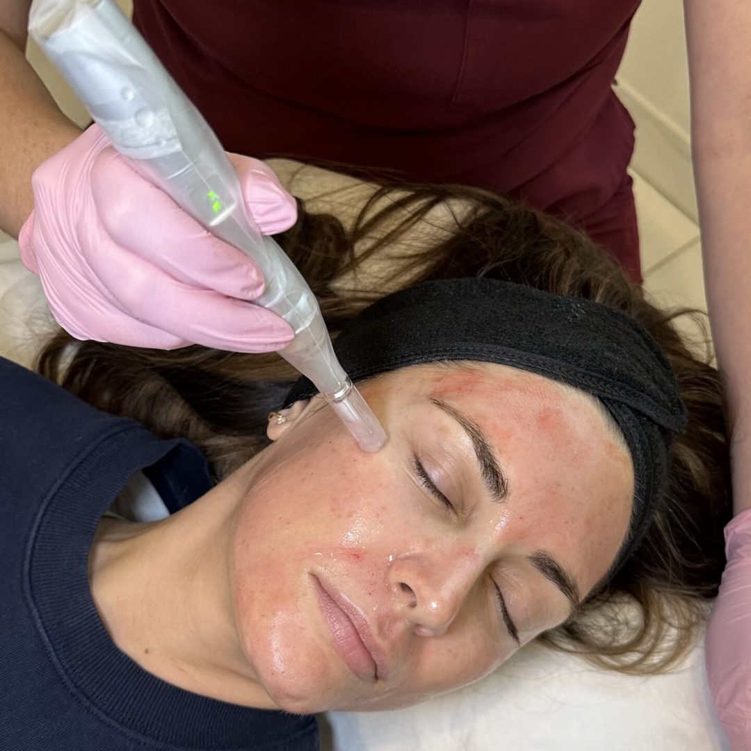 Microneedling - Canada MedLaser