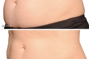 Before and after coolsculpting treatment at CML